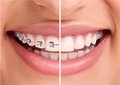 aligners-braces